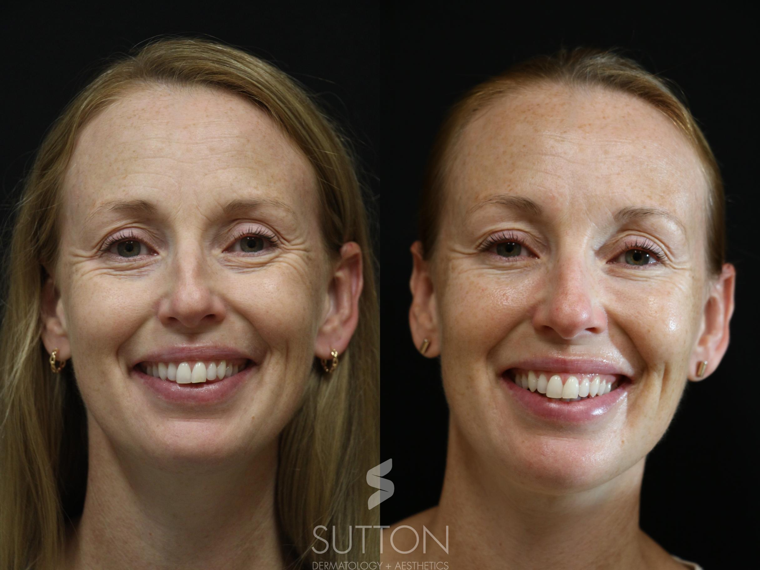 Before & After Dermal Fillers Case 54 Front View in Lincoln, NE