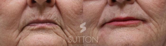 Before & After Dermal Fillers Case 60 Front View in Lincoln, NE