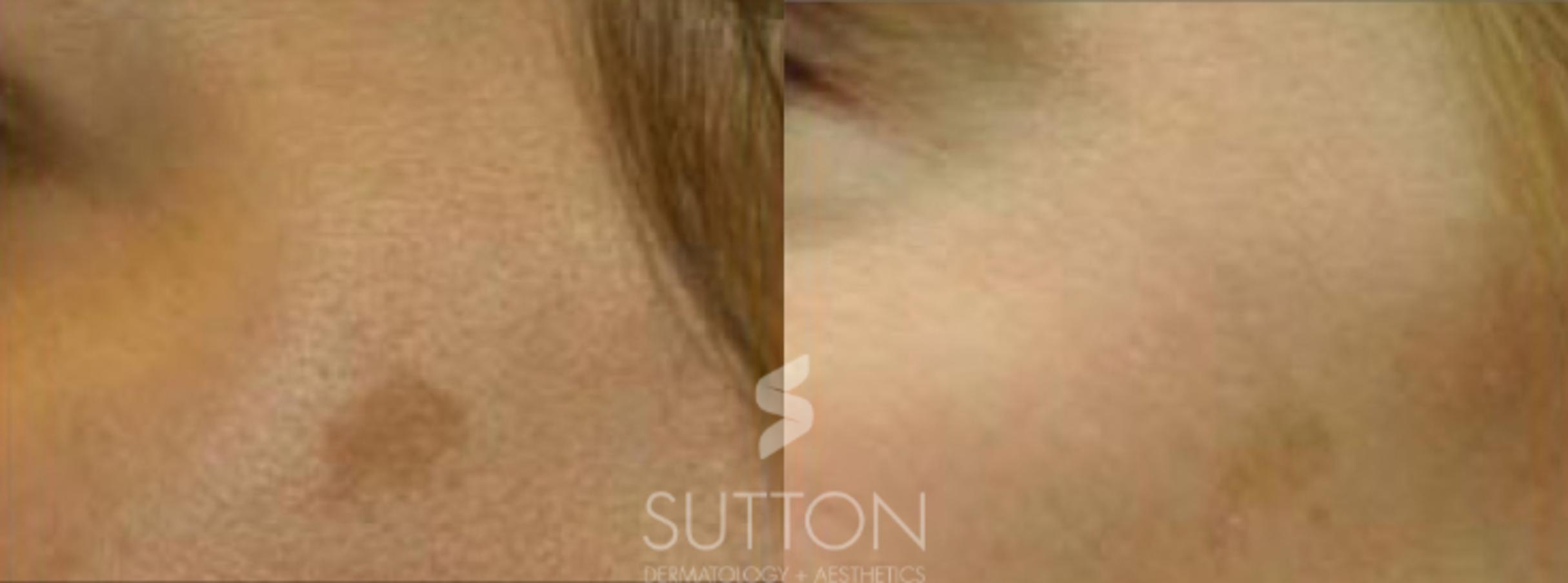 Before & After Laser Treatments Case 40 Left Side View in Lincoln, NE