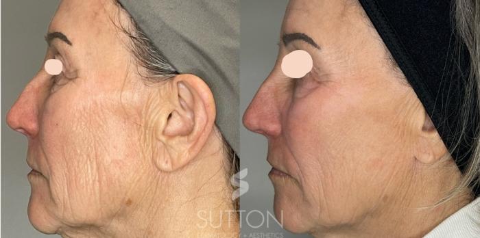 Before & After Tetra CoolPeel® Case 56 Left Side View in Lincoln, NE