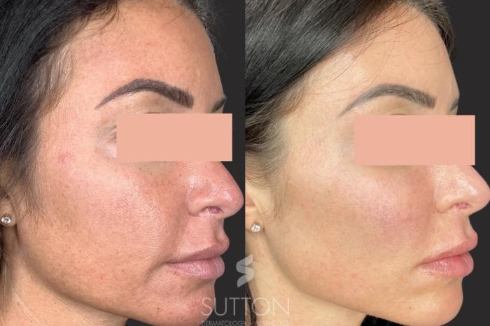 Before & After Tetra CoolPeel® Case 57 Left Side View in Lincoln, NE