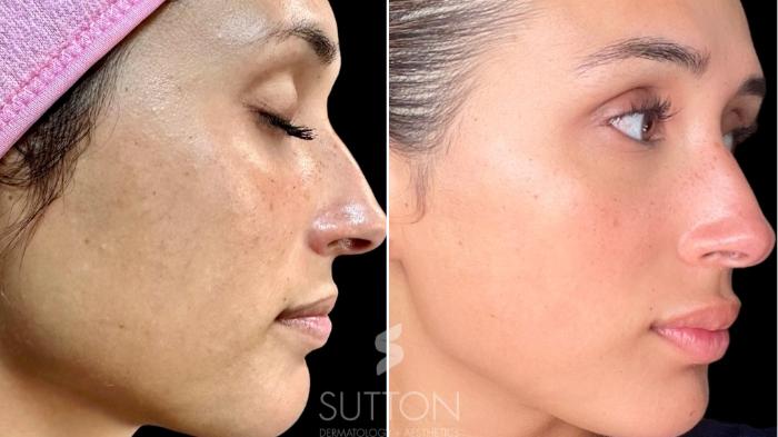 Before & After Tetra CoolPeel® Case 58 Right Side View in Lincoln, NE