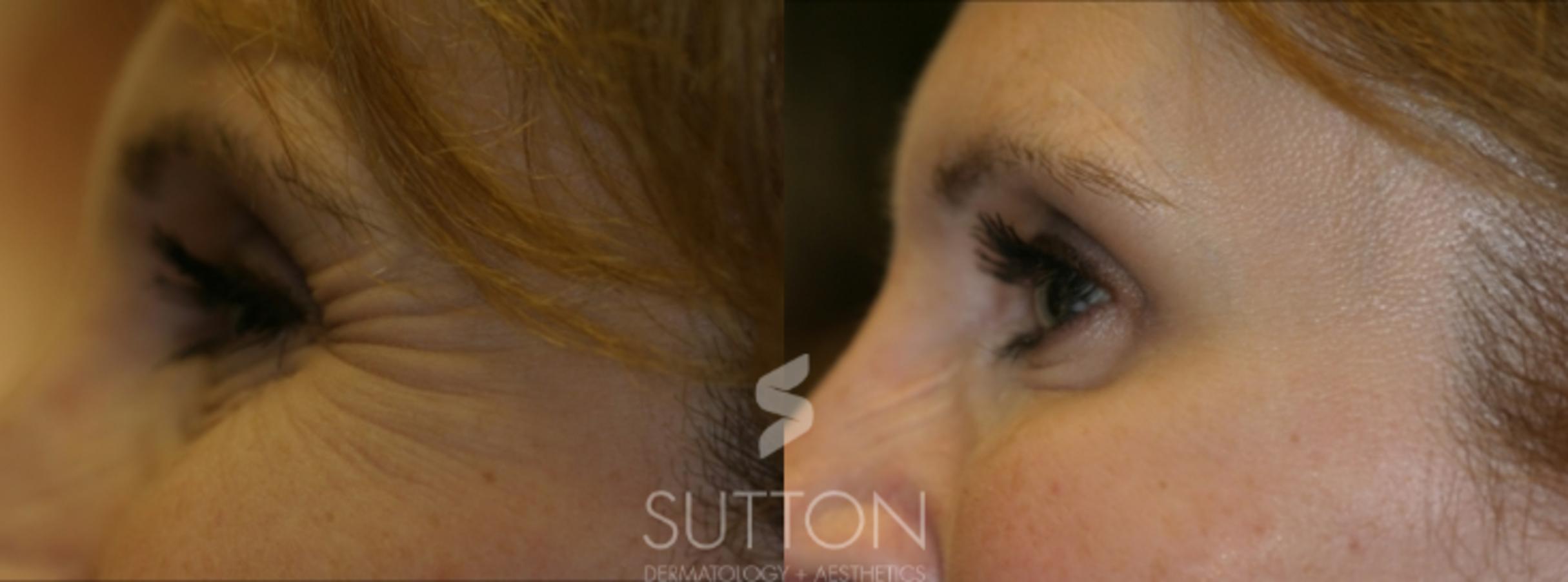 Before & After BOTOX® & Dysport® Case 2 Left Side View in Lincoln, NE