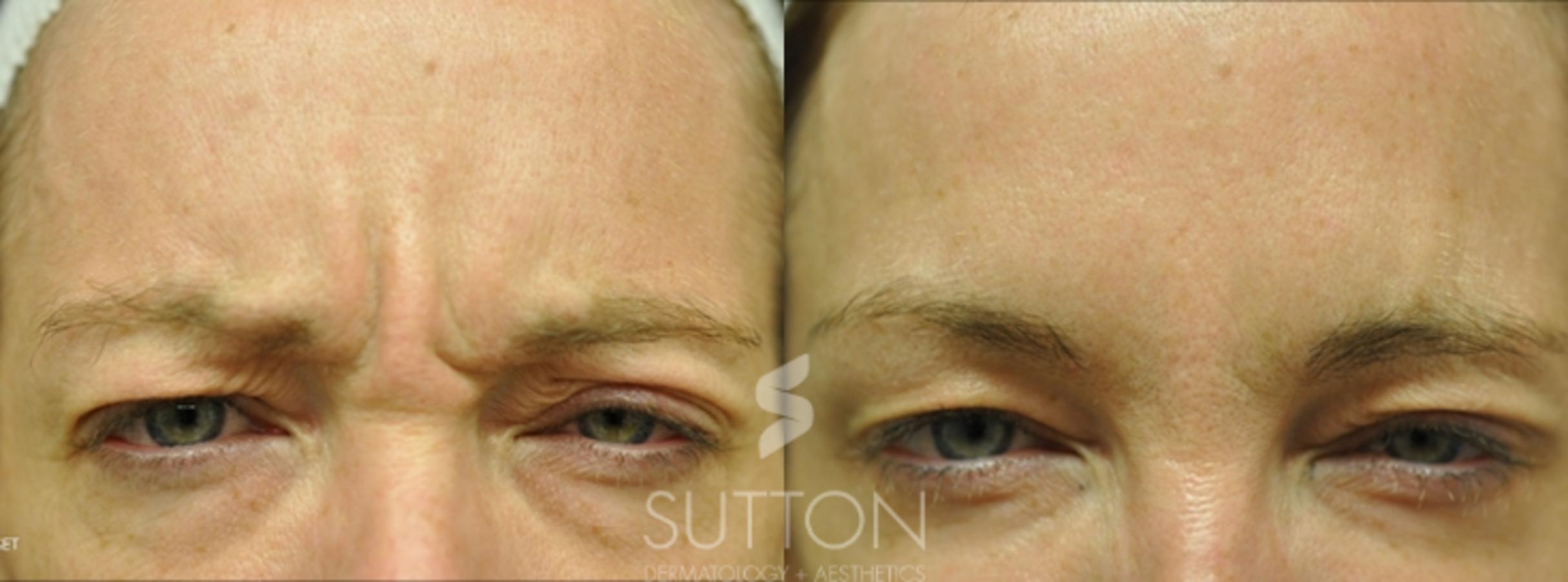 Before & After BOTOX® & Dysport® Case 3 Front View in Lincoln, NE