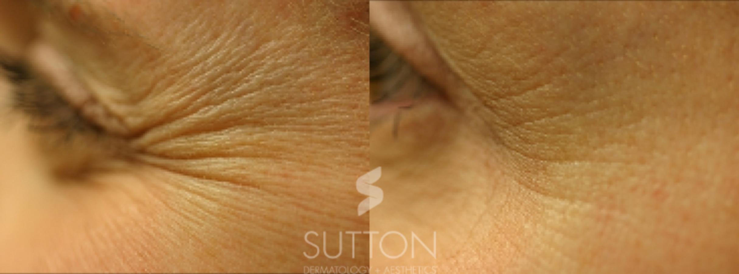 Before & After BOTOX® & Dysport® Case 4 Left Side View in Lincoln, NE