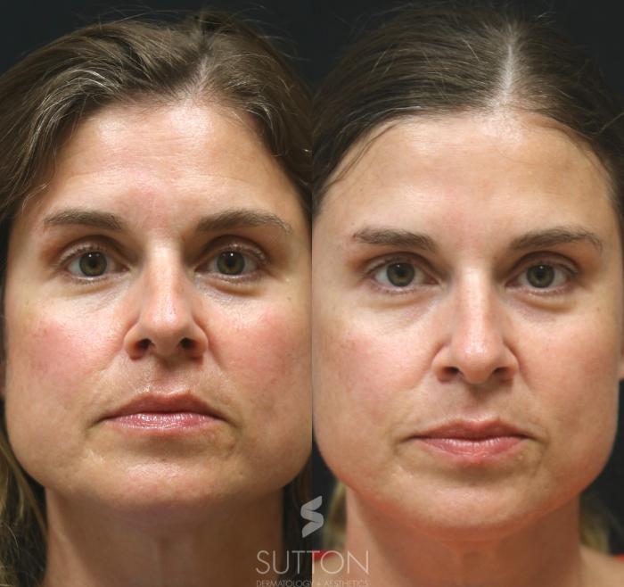 Before & After BOTOX® & Dysport® Case 47 Front View in Lincoln, NE