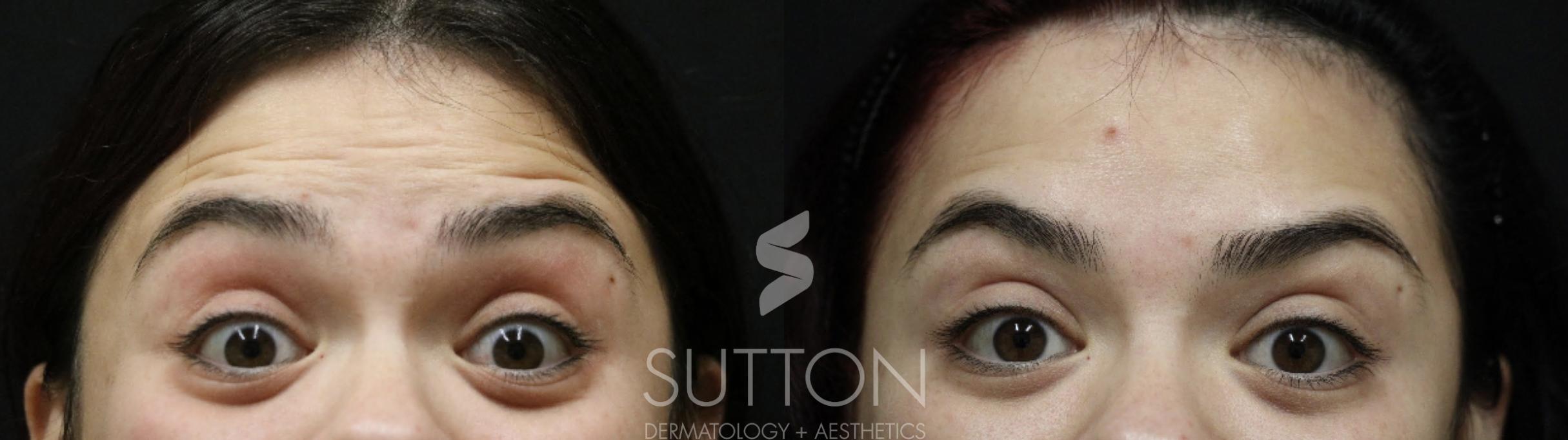 Before & After BOTOX® & Dysport® Case 55 Front View in Lincoln, NE