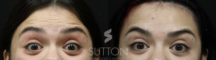 Before & After BOTOX® & Dysport® Case 55 Front View in Lincoln, NE