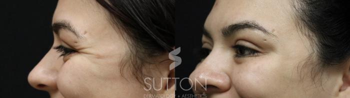 Before & After BOTOX® & Dysport® Case 55 Left Side View in Lincoln, NE
