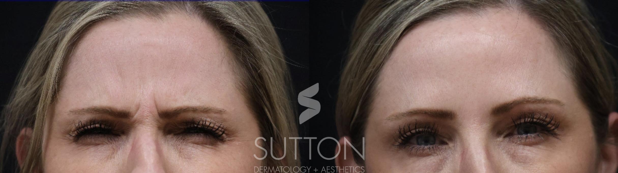 Before & After BOTOX® & Dysport® Case 59 Front View in Lincoln, NE