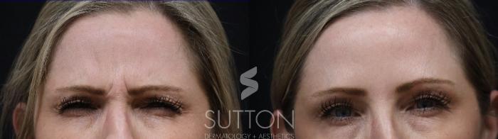 Before & After BOTOX® & Dysport® Case 59 Front View in Lincoln, NE