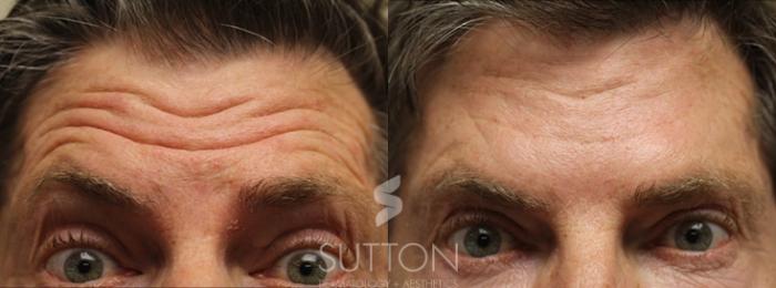 Before & After BOTOX® & Dysport® Case 6 Front View in Lincoln, NE