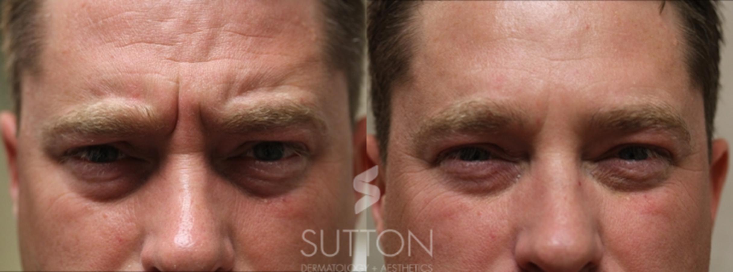 Before & After BOTOX® & Dysport® Case 9 Front View in Lincoln, NE