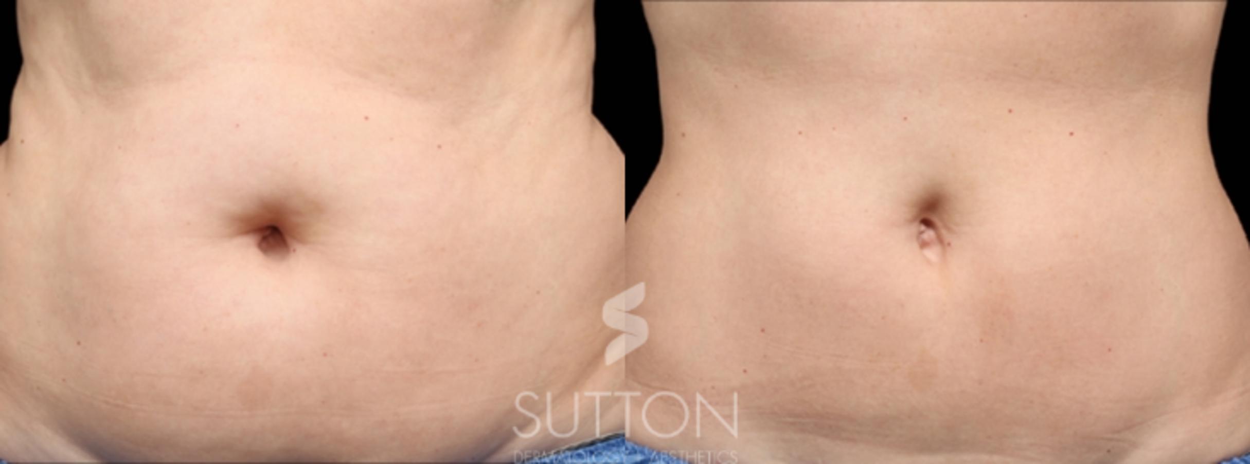 Before & After CoolSculpting Case 11 Front View in Lincoln, NE