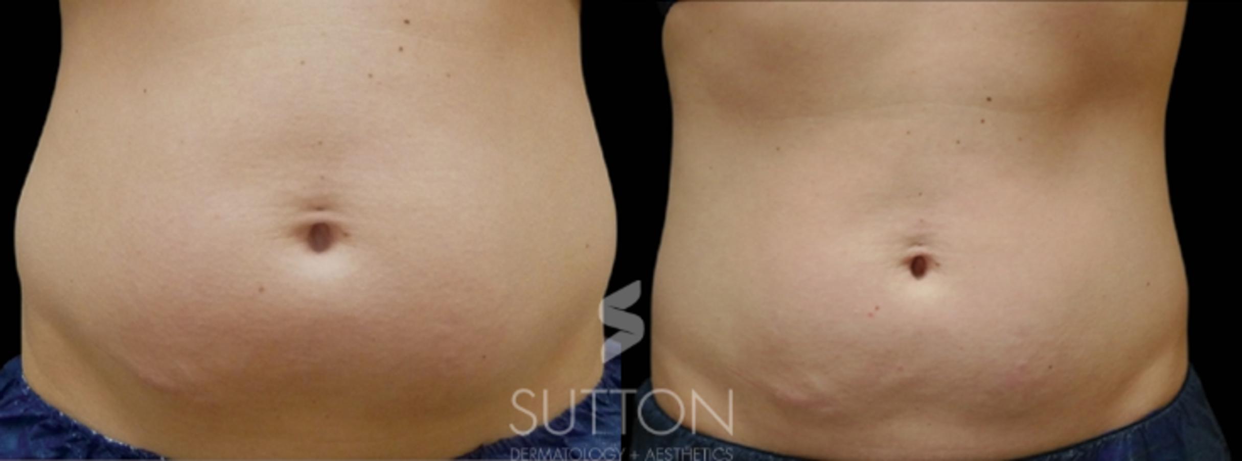 Before & After CoolSculpting Case 13 Front View in Lincoln, NE