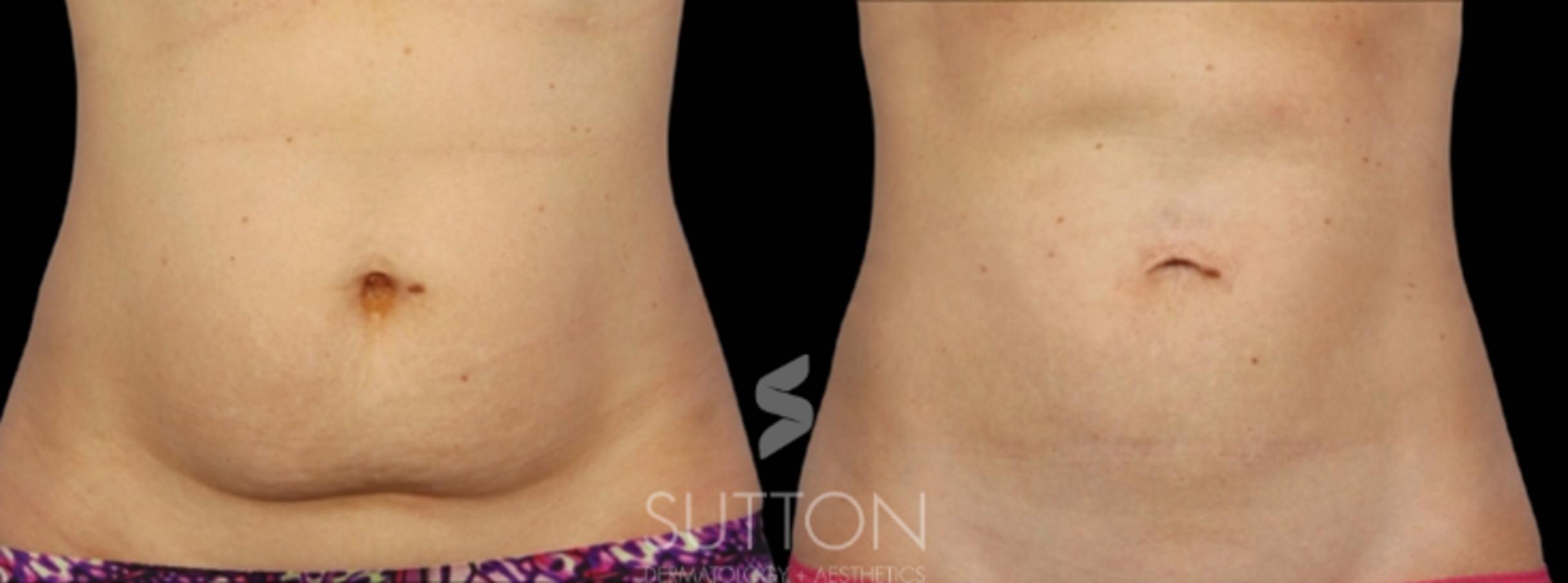 Before & After CoolSculpting Case 14 Front View in Lincoln, NE