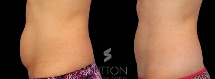 Before & After CoolSculpting Case 15 Left Side View in Lincoln, NE