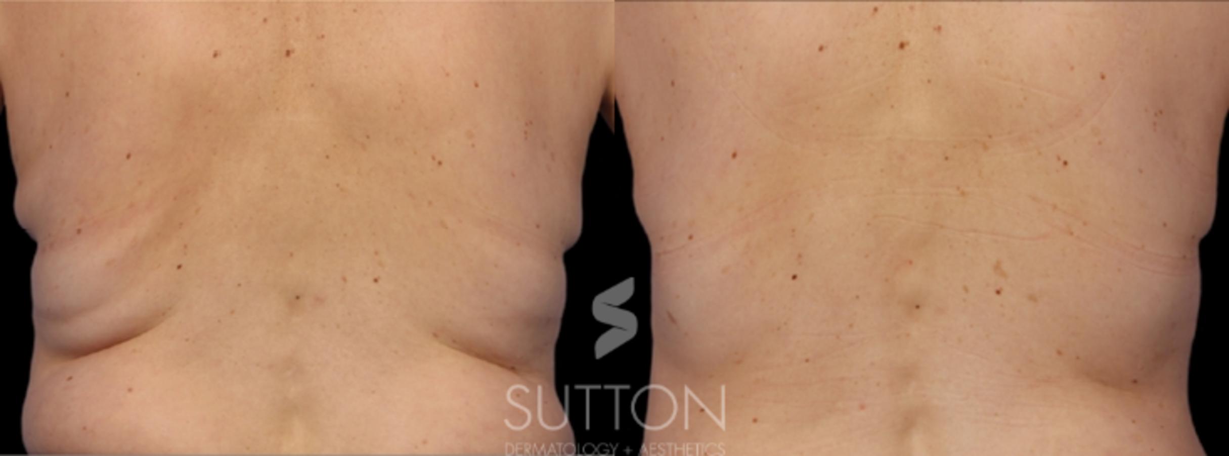 Before & After CoolSculpting Case 16 Back View in Lincoln, NE