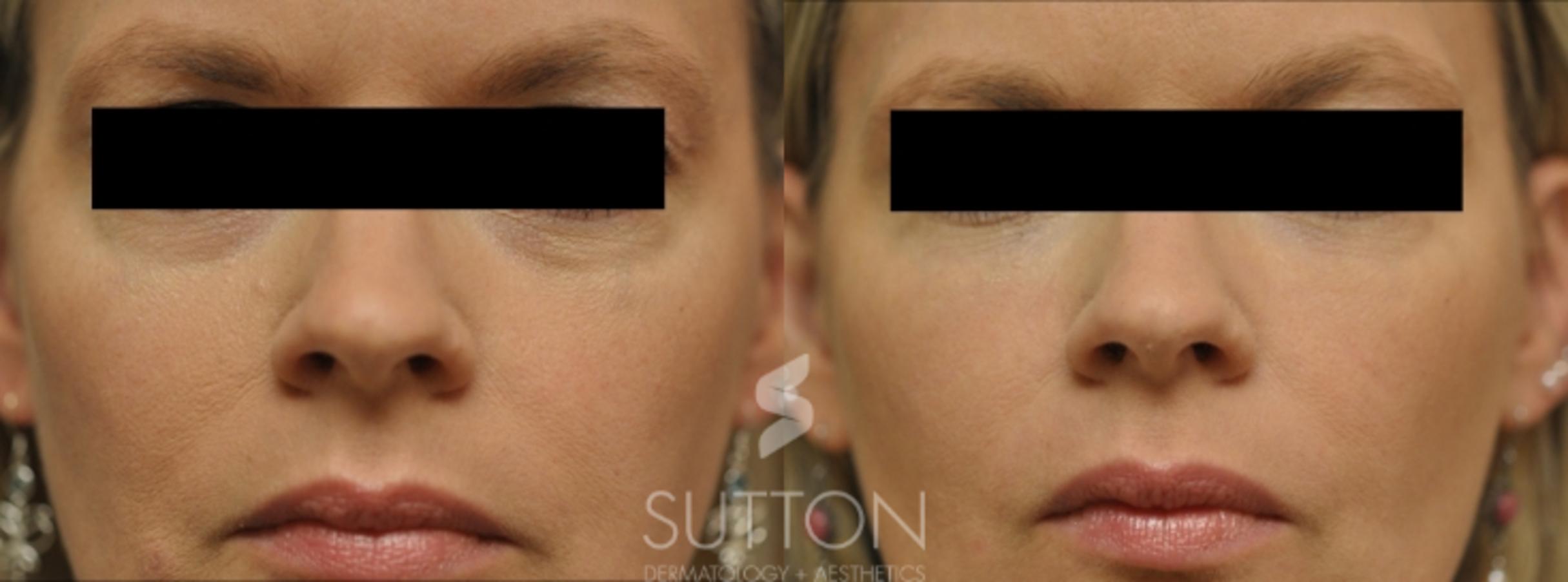Before & After Dermal Fillers Case 18 Front View in Lincoln, NE
