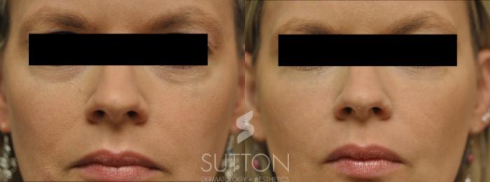 Before & After Dermal Fillers Case 18 Front View in Lincoln, NE