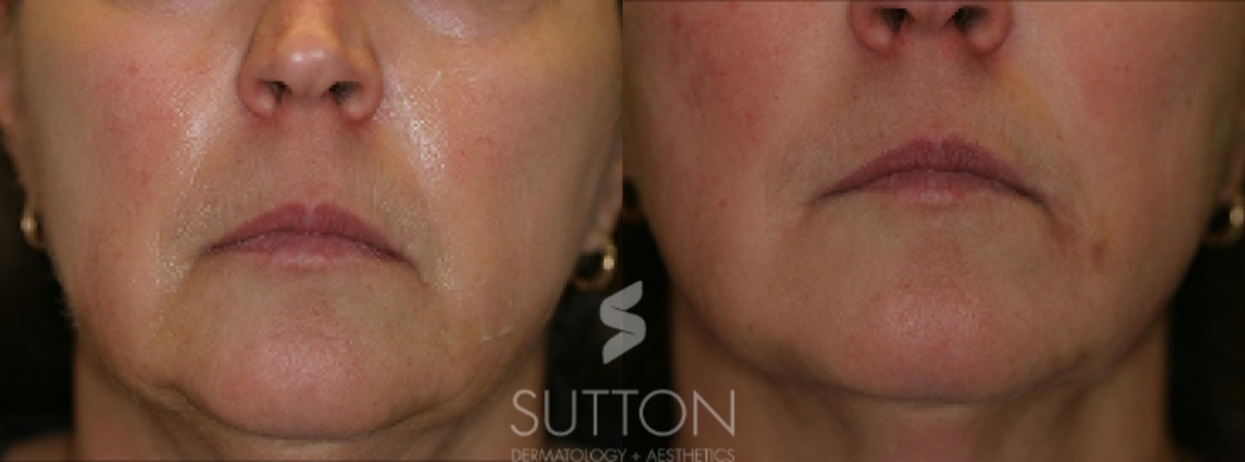 Before & After Dermal Fillers Case 22 Front View in Lincoln, NE