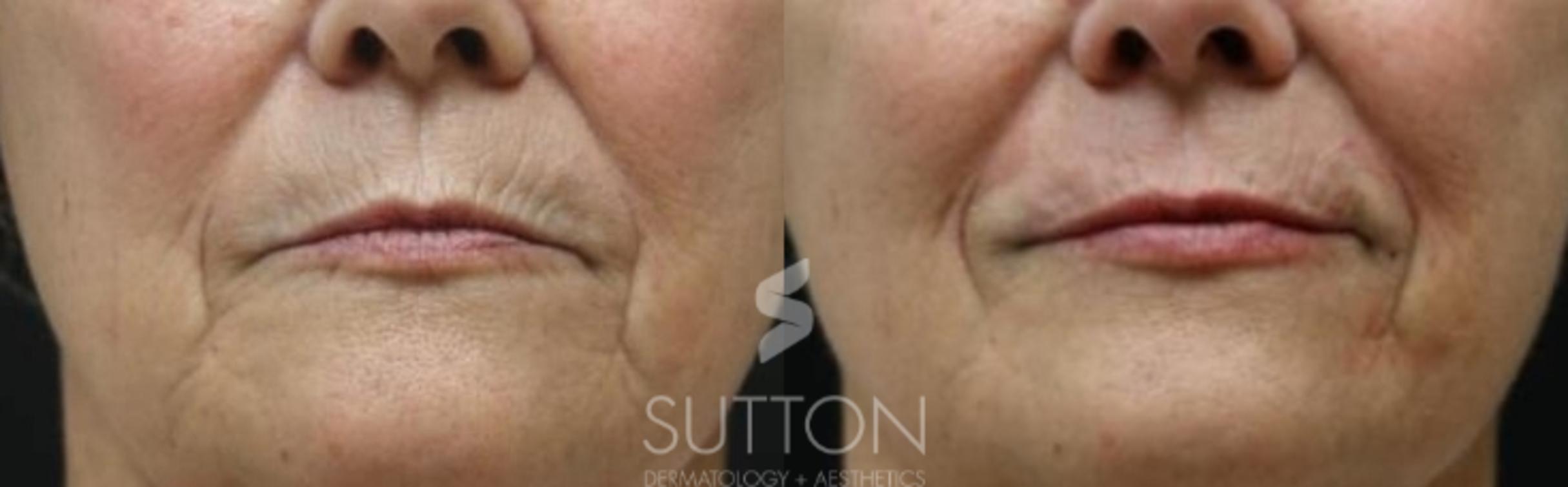 Before & After Dermal Fillers Case 27 Front View in Lincoln, NE