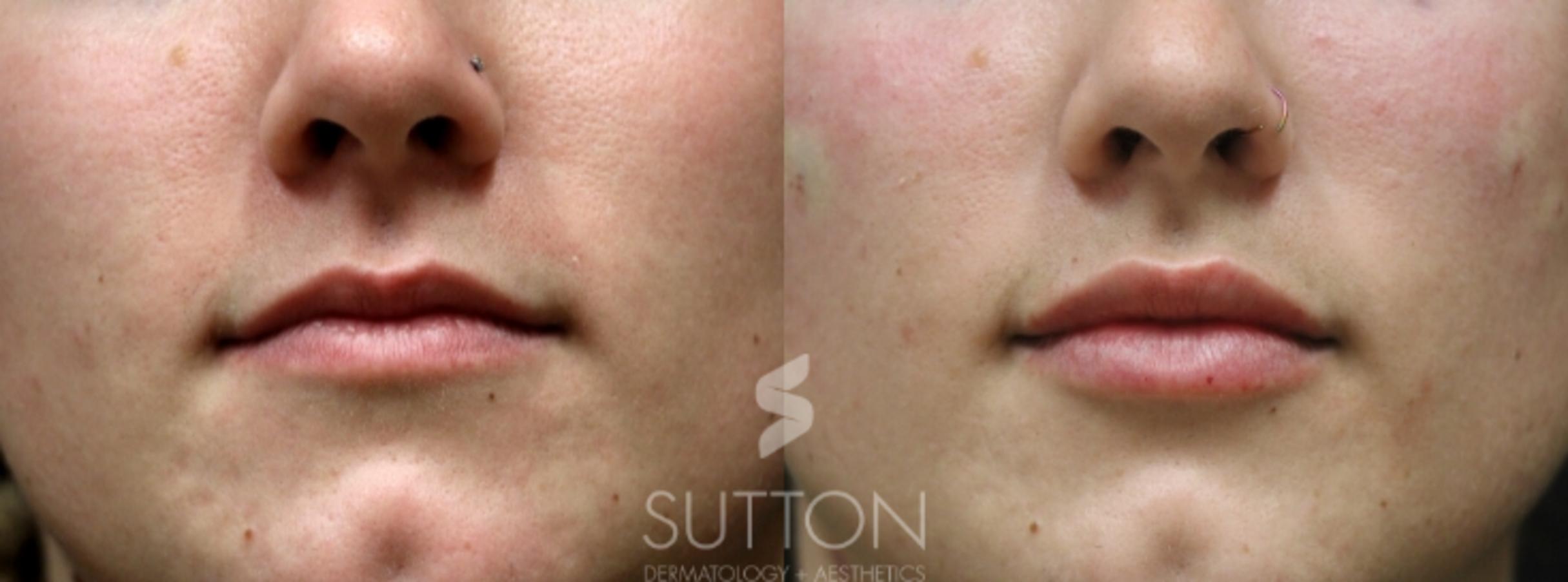 Before & After Dermal Fillers Case 28 Front View in Lincoln, NE