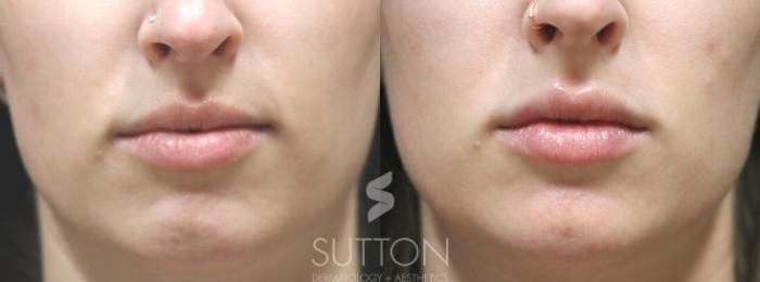 Before & After Dermal Fillers Case 29 Front View in Lincoln, NE