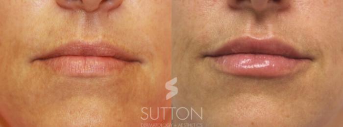 Before & After Dermal Fillers Case 30 Front View in Lincoln, NE