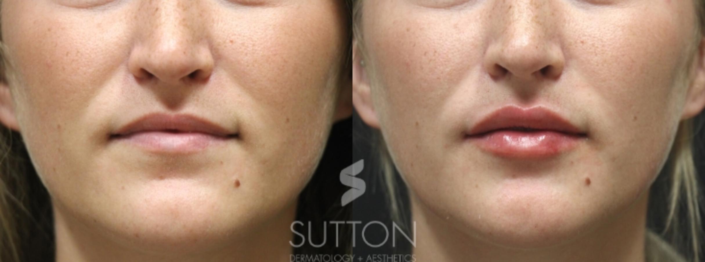 Before & After Dermal Fillers Case 31 Front View in Lincoln, NE