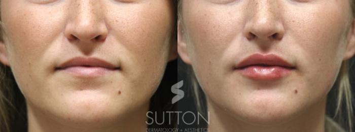 Before & After Dermal Fillers Case 31 Front View in Lincoln, NE