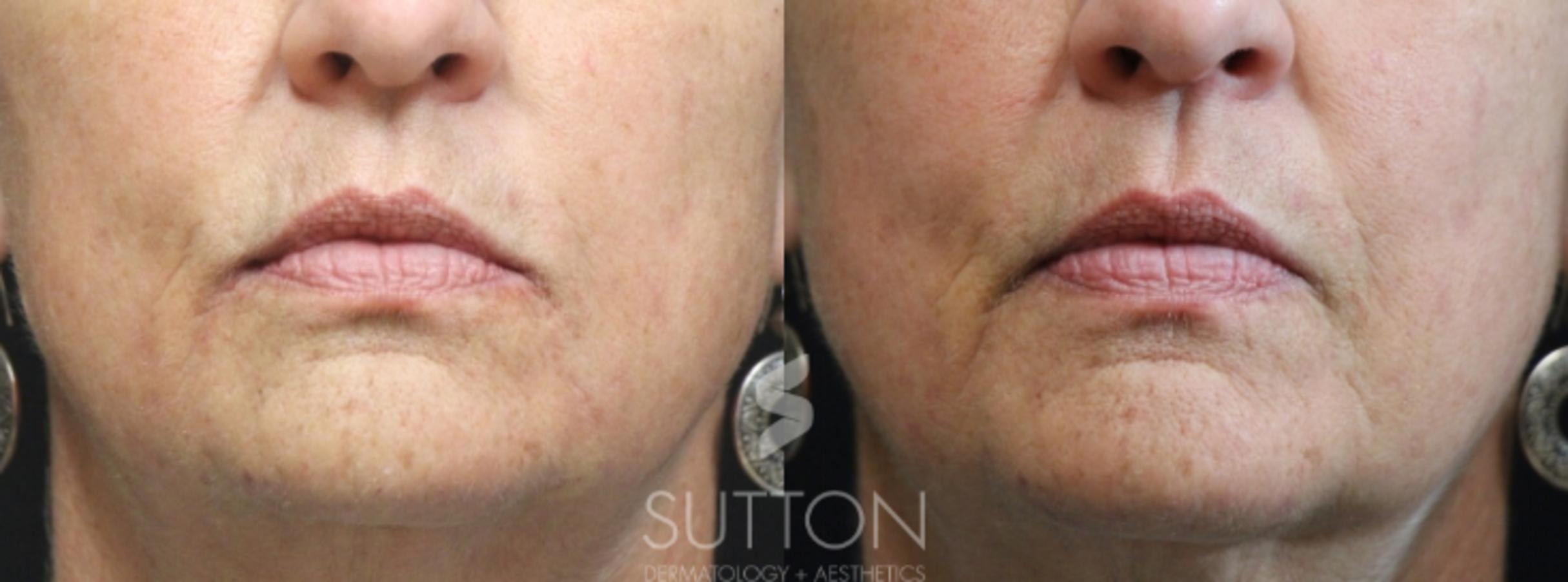 Before & After Dermal Fillers Case 33 Front View in Lincoln, NE