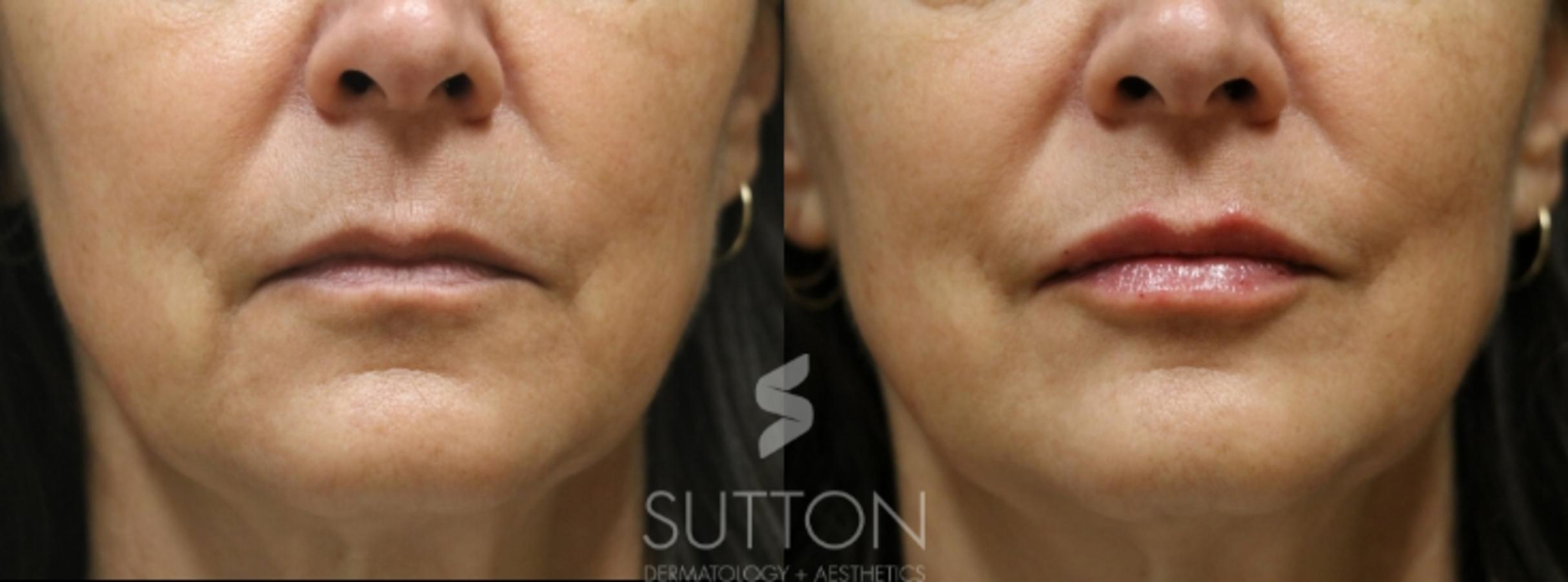 Before & After Dermal Fillers Case 34 Front View in Lincoln, NE