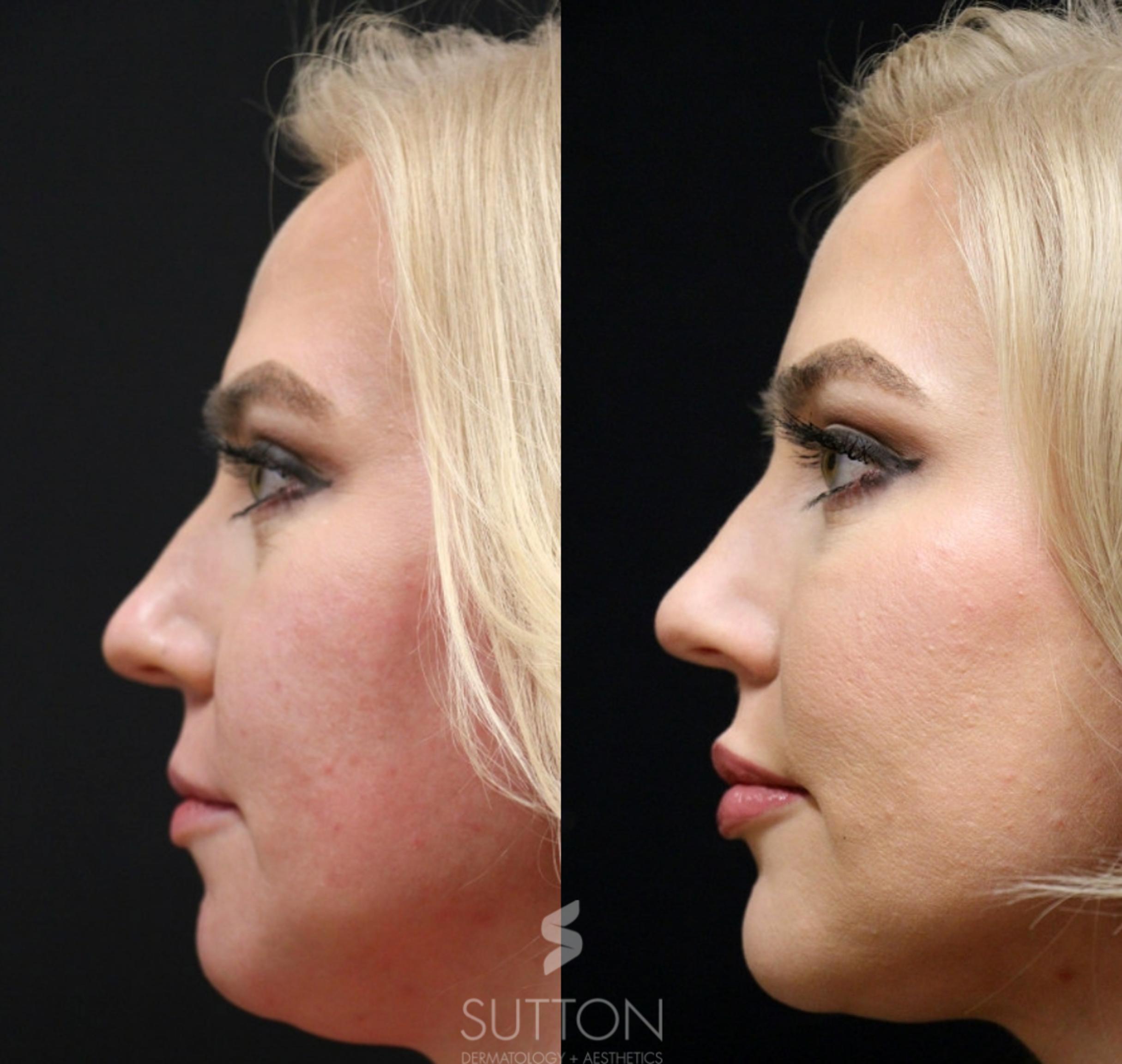 Before & After Dermal Fillers Case 43 Left Side View in Lincoln, NE