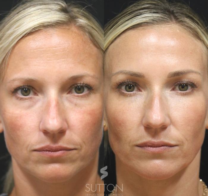 Before & After Dermal Fillers Case 45 Front View in Lincoln, NE