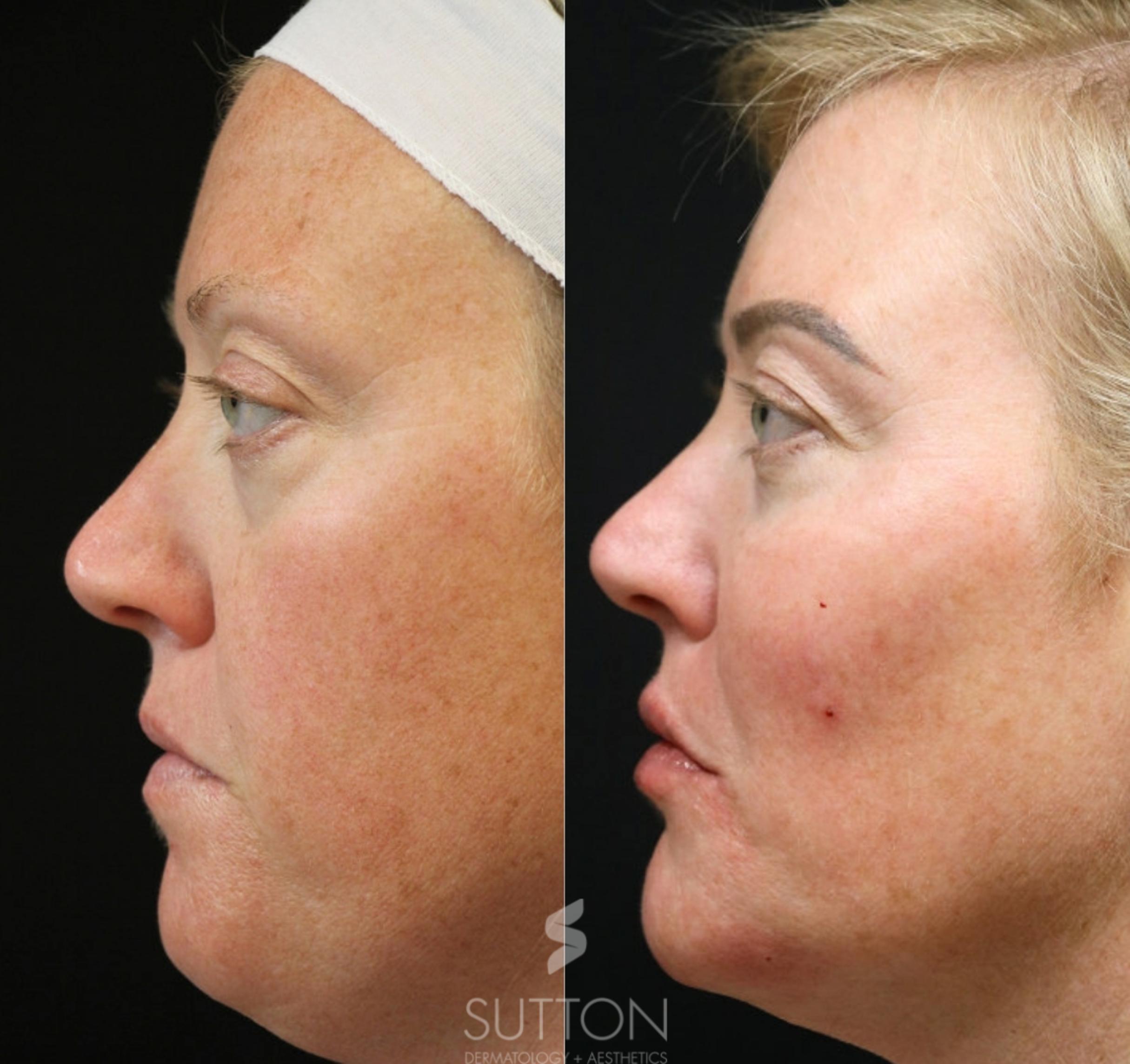 Before & After Dermal Fillers Case 51 Left Side View in Lincoln, NE