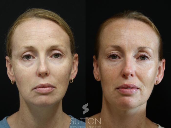 Before & After Dermal Fillers Case 53 Front View in Lincoln, NE