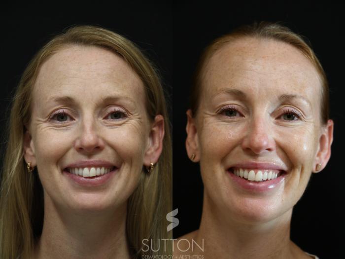 Before & After Dermal Fillers Case 53 Left Side View in Lincoln, NE