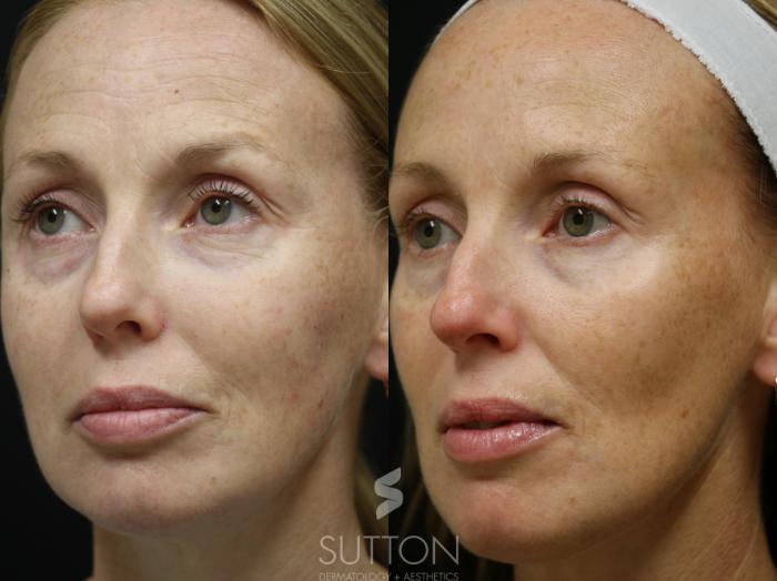 Before & After Dermal Fillers Case 54 Left Oblique View in Lincoln, NE