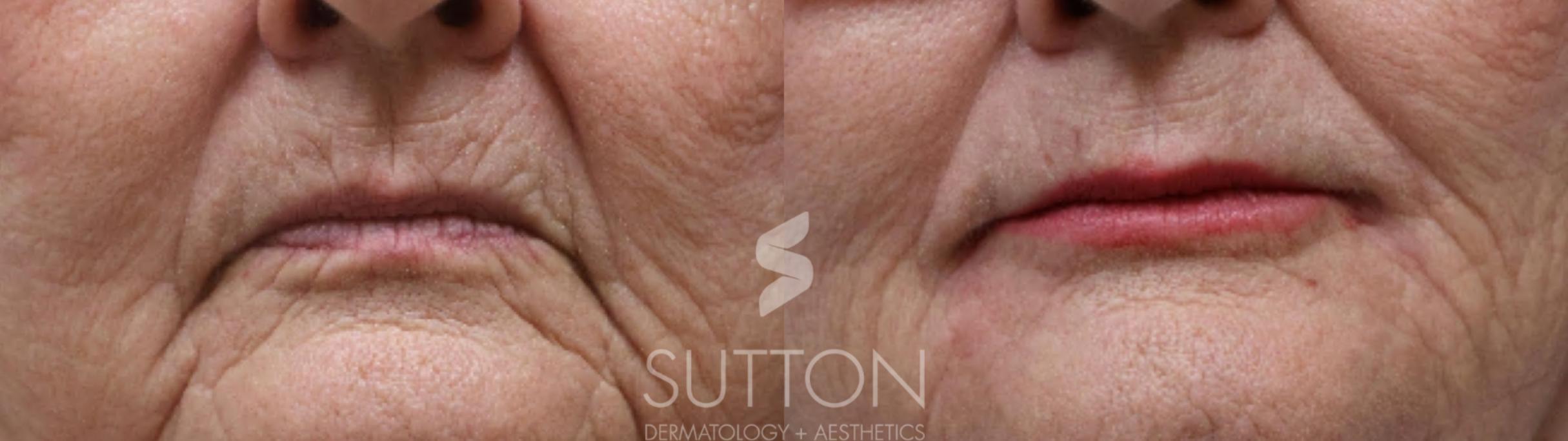 Before & After Dermal Fillers Case 60 Front View in Lincoln, NE