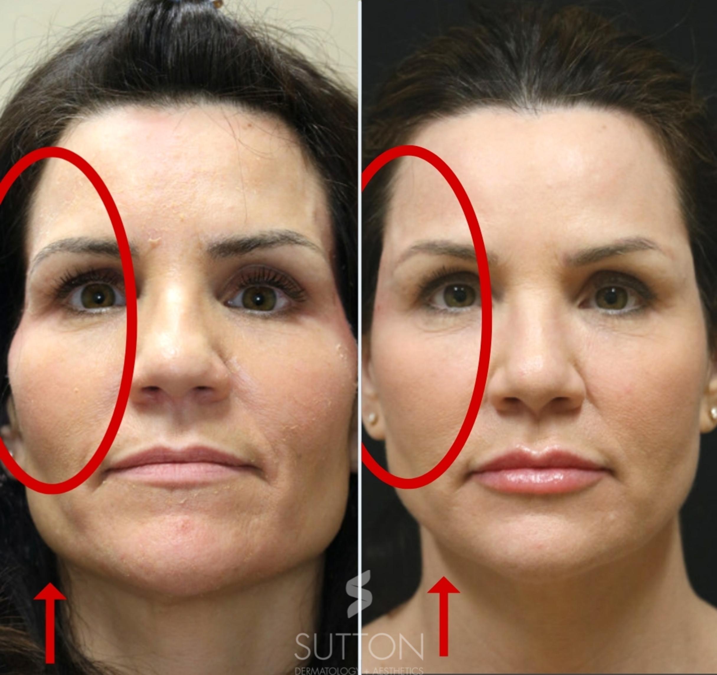 Before & After Dermal Fillers Case 61 Front View in Lincoln, NE