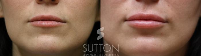 Before & After Dermal Fillers Case 65 Front View in Lincoln, NE