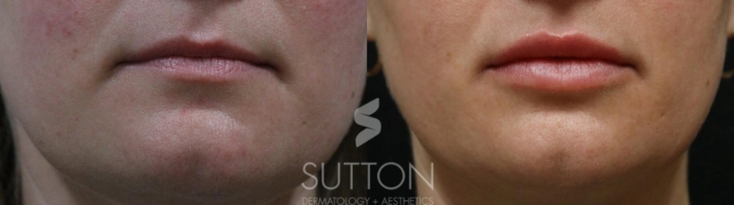 Before & After Dermal Fillers Case 66 Front View in Lincoln, NE