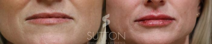 Before & After Dermal Fillers Case 67 Front View in Lincoln, NE