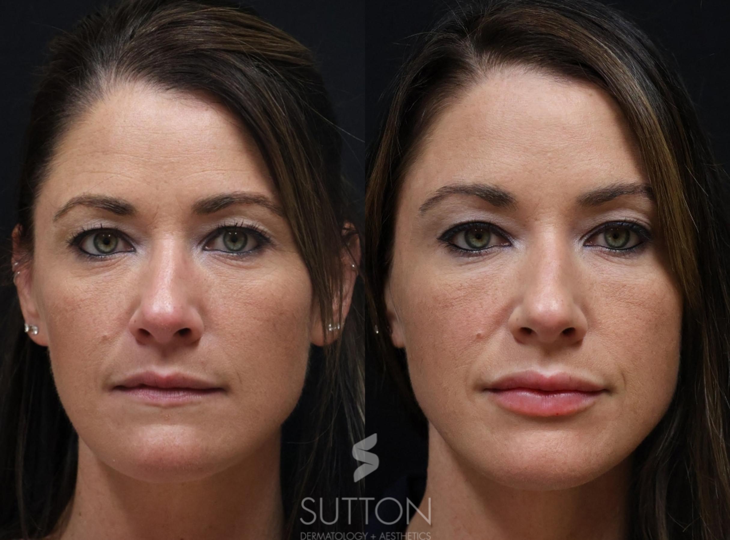 Before & After Dermal Fillers Case 68 Front View in Lincoln, NE