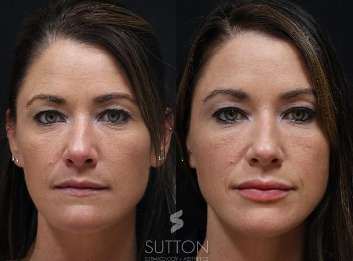 Before & After Dermal Fillers Case 68 Front View in Lincoln, NE