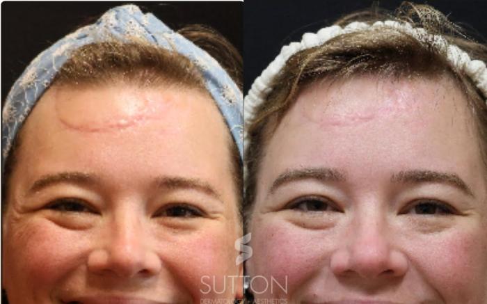 Before & After Laser Treatments Case 62 Front View in Lincoln, NE